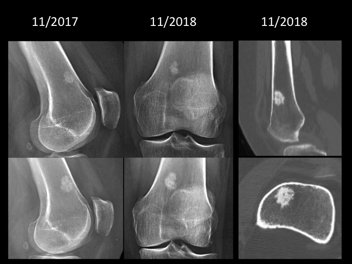 Figure 2 for case bone island ( RID4004 )